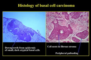 Histology of basal cell carcinoma Downgrowth from epidermis of small, dark atypical basal cells Peripheral palisading Cell nests in fibrous stroma 