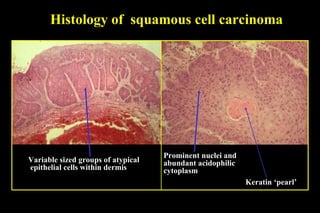 Prominent nuclei and abundant acidophilic  cytoplasm Variable sized groups of atypical epithelial cells within dermis Histology of  squamous cell carcinoma Keratin ‘pearl’ 