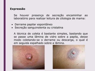 Expressão
Se houver presença de secreção encaminhar ao
laboratório para realizar leitura de citologia de mama:
 Derrame papilar espontâneo
 Secreção sanguinolenta ou cristalina
A técnica de coleta é bastante simples, bastando que
se passe uma lâmina de vidro sobre a papila, desse
modo coletando-se o derrame ou descarga, o qual é
em seguida espalhado sobre a lâmina.
 