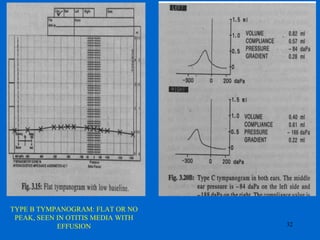 TYPE B TYMPANOGRAM: FLAT OR NO
PEAK, SEEN IN OTITIS MEDIA WITH
EFFUSION 32
 