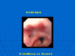 ES  FAGO Divert  culo de Zenker 