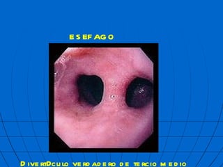 ES  FAGO Divert  culo verdadero de tercio medio 