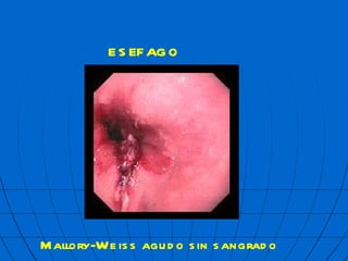 ES  FAGO Mallory-Weiss agudo sin sangrado 