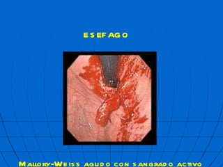 ES  FAGO Mallory-Weiss agudo con sangrado activo 