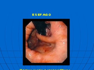 Hernia hiatal paraesof  gica ES  FAGO 