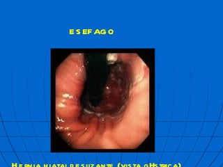 Hernia hiatal deslizante (vista g  strica) ES  FAGO 