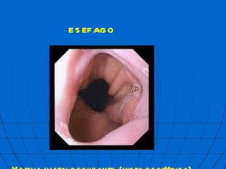Hernia hiatal deslizante (vista esof  gica) ES  FAGO 