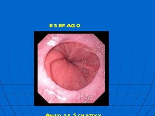 Anillo de Schatzky ES  FAGO 