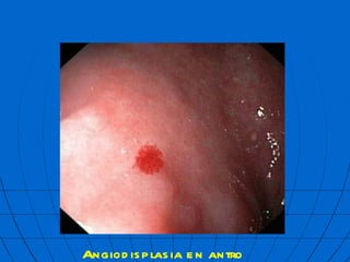 Angiodisplasia en antro  mbf 