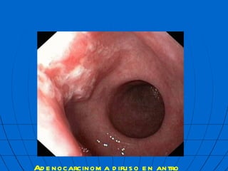 Adenocarcinoma difuso en antro  mbf 