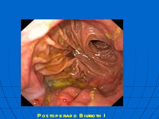 Postoperado Bilrroth I  mbf 