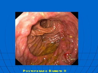 Postoperado Bilrroth II  mbf 