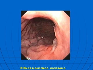 C  ncer g  strico ulcerado  mbf 