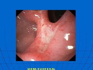  lcera duodenal  mbf 