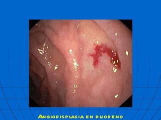 Angiodisplasia en duodeno  mbf 