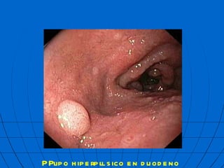 P  lipo hiperpl  sico en duodeno  mbf 