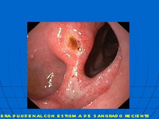  lcera duodenal con estigma de sangrado reciente mbf 