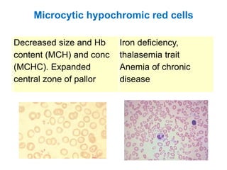 Microcytic hypochromic red cells
Decreased size and Hb
content (MCH) and conc
(MCHC). Expanded
central zone of pallor
Iron deficiency,
thalasemia trait
Anemia of chronic
disease
 