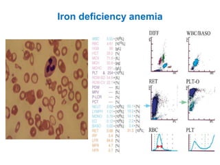 Iron deficiency anemia
 