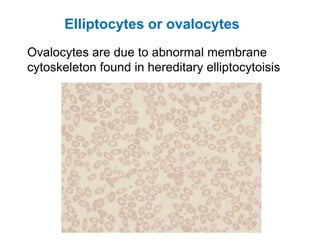 Elliptocytes or ovalocytes
Ovalocytes are due to abnormal membrane
cytoskeleton found in hereditary elliptocytoisis
 