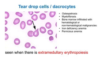 seen when there is extramedullary erythropoiesis
Tear drop cells / dacrocytes
• Osteopetrosis
• Myelofibrosis
• Bone marrow infiltrated with
hematological or
non-hematological malignancies
• Iron deficiency anemia
• Pernicious anemia
 