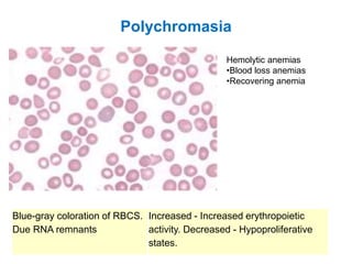 Polychromasia
Blue-gray coloration of RBCS.
Due RNA remnants
Increased - Increased erythropoietic
activity. Decreased - Hypoproliferative
states.
Hemolytic anemias
•Blood loss anemias
•Recovering anemia
 