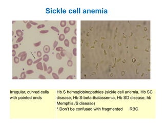 Sickle cell anemia
Irregular, curved cells
with pointed ends
Hb S hemoglobinopathies (sickle cell anemia, Hb SC
disease, Hb S-beta-thalassemia, Hb SD disease, hb
Memphis /S disease)
* Don’t be confused with fragmented RBC
 