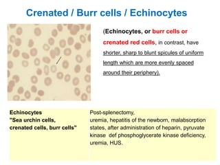 Echinocytes
"Sea urchin cells,
crenated cells, burr cells"
Post-splenectomy,
uremia, hepatitis of the newborn, malabsorption
states, after administration of heparin, pyruvate
kinase def phosphoglycerate kinase deficiency,
uremia, HUS.
Crenated / Burr cells / Echinocytes
(Echinocytes, or burr cells or
crenated red cells, in contrast, have
shorter, sharp to blunt spicules of uniform
length which are more evenly spaced
around their periphery).
 