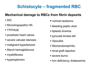 Mechanical damage to RBCs from fibrin deposits
 DIC
 MicroAngiopathic HA
 TTP/HUS
 prosthetic heart valves
 severe valvular stenosis
 malignant hypertension
 March hemoglobinuria
 myelofibrosis
 hypersplenism
Schistocyte – fragmented RBC
 normal newborns
 bleeding peptic ulcer
 Aplastic Anemia
 pyruvate kinase def
 Vasculitis
 Glomerulonephritis
 renal graft rejection
 severe burns
 iron deficiency, thalassemia
 