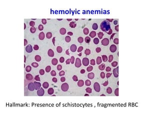 hemolyic anemias
Hallmark: Presence of schistocytes , fragmented RBC
 