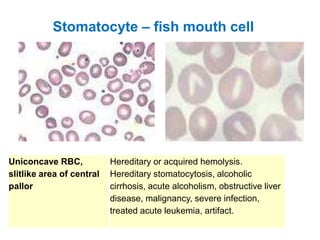 Uniconcave RBC,
slitlike area of central
pallor
Hereditary or acquired hemolysis.
Hereditary stomatocytosis, alcoholic
cirrhosis, acute alcoholism, obstructive liver
disease, malignancy, severe infection,
treated acute leukemia, artifact.
Stomatocyte – fish mouth cell
 