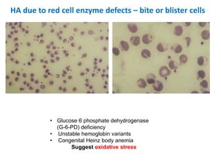 HA due to red cell enzyme defects – bite or blister cells
• Glucose 6 phosphate dehydrogenase
(G-6-PD) deficiency
• Unstable hemoglobin variants
• Congenital Heinz body anemia
Suggest oxidative stress
 