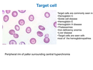 Target cell
Peripheral rim of pallor surrounding central hyperchromia
Target cells are commonly seen in
•Hemoglobin C
•Sickle cell disease
•Hemoglobin E
•Hemoglobin H disease
•Thalassemias
•Iron deficiency anemia
•Liver disease
•Target cells are seen with
most of the hemoglobinopathies
 