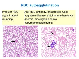 Irregular RBC
agglutination/
clumping
Anti-RBC antibody, paraprotein. Cold
agglutinin disease, autoimmune hemolytic
anemia, macroglobulinemia,
hypergammaglobinemia
RBC autoagglutination
 