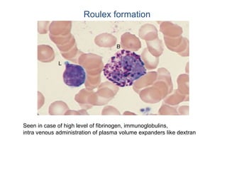 Roulex formation
Seen in case of high level of fibrinogen, immunoglobulins,
intra venous administration of plasma volume expanders like dextran
 