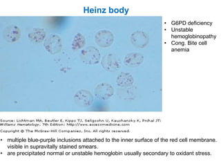 • multiple blue-purple inclusions attached to the inner surface of the red cell membrane.
visible in supravitally stained smears.
• are precipitated normal or unstable hemoglobin usually secondary to oxidant stress.
• G6PD deficiency
• Unstable
hemoglobinopathy
• Cong. Bite cell
anemia
Heinz body
 