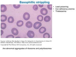 Basophillic strippling
• Lead poisoning
• Iron deficiency anemia
• Thalassemia
Are abnormal aggregrates of ribosome and polyribosomes
 