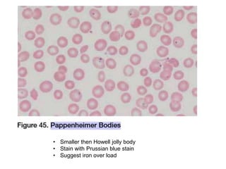 • Smaller then Howell jolly body
• Stain with Prussian blue stain
• Suggest iron over load
 