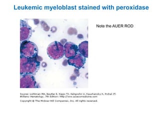 Leukemic myeloblast stained with peroxidase
Note the AUER ROD
 
