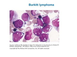 Burkitt lymphoma
 