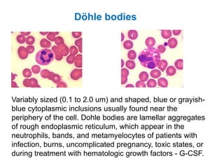 Variably sized (0.1 to 2.0 um) and shaped, blue or grayish-
blue cytoplasmic inclusions usually found near the
periphery of the cell. Dohle bodies are lamellar aggregates
of rough endoplasmic reticulum, which appear in the
neutrophils, bands, and metamyelocytes of patients with
infection, burns, uncomplicated pregnancy, toxic states, or
during treatment with hematologic growth factors - G-CSF.
Döhle bodies
 