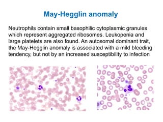 May-Hegglin anomaly
Neutrophils contain small basophilic cytoplasmic granules
which represent aggregated ribosomes. Leukopenia and
large platelets are also found. An autosomal dominant trait,
the May-Hegglin anomaly is associated with a mild bleeding
tendency, but not by an increased susceptibility to infection
 