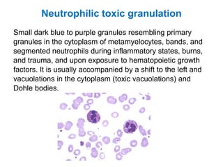 Neutrophilic toxic granulation
Small dark blue to purple granules resembling primary
granules in the cytoplasm of metamyelocytes, bands, and
segmented neutrophils during inflammatory states, burns,
and trauma, and upon exposure to hematopoietic growth
factors. It is usually accompanied by a shift to the left and
vacuolations in the cytoplasm (toxic vacuolations) and
Dohle bodies.
 