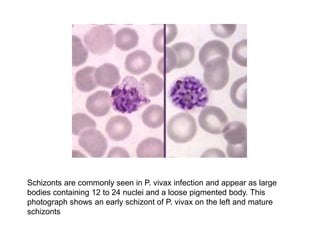 Schizonts are commonly seen in P. vivax infection and appear as large
bodies containing 12 to 24 nuclei and a loose pigmented body. This
photograph shows an early schizont of P. vivax on the left and mature
schizonts
 