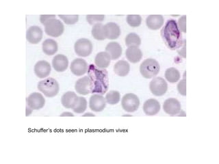 Schuffer’s dots seen in plasmodium vivex
 