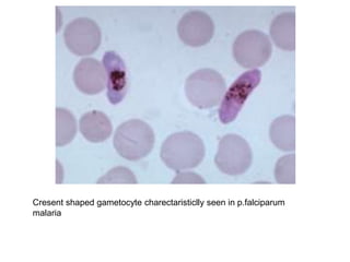 Cresent shaped gametocyte charectaristiclly seen in p.falciparum
malaria
 