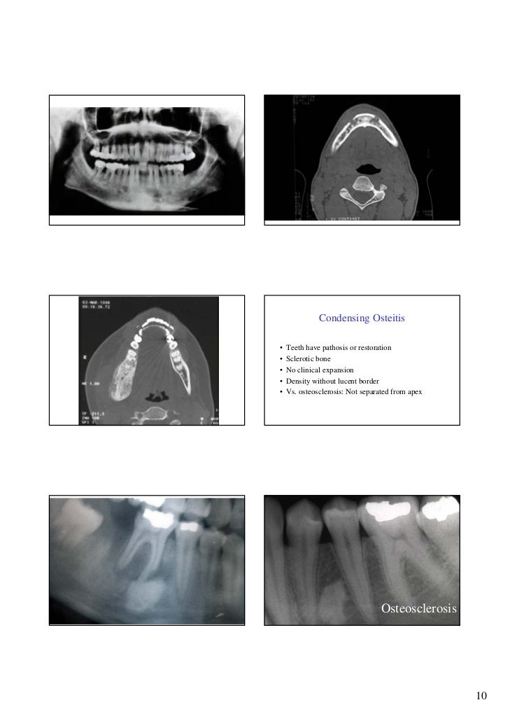 05 pulp, periapical, osteomyelitis