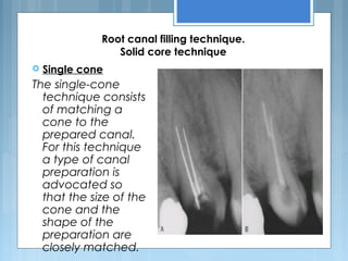 Root canal filling technique.
Solid core technique
 Single cone
The single-cone
technique consists
of matching a
cone to the
prepared canal.
For this technique
a type of canal
preparation is
advocated so
that the size of the
cone and the
shape of the
preparation are
closely matched.
 