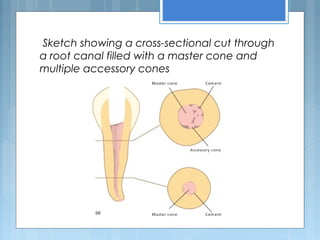 Sketch showing a cross-sectional cut through
a root canal filled with a master cone and
multiple accessory cones
 