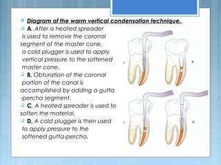  Diagram of the warm vertical condensation technique.
 A, After a heated spreader
is used to remove the coronal
segment of the master cone,
a cold plugger is used to apply
vertical pressure to the softened
master cone.
 B, Obturation of the coronal
portion of the canal is
accomplished by adding a gutta
-percha segment.
 C, A heated spreader is used to
soften the material.
 D, A cold plugger is then used
to apply pressure to the
softened gutta-percha.
 